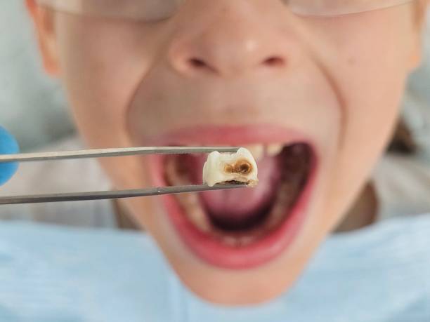 Best Emergency Dentist for Lost Fillings or Crowns in Mccom, OH